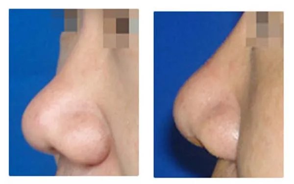 天津膨体隆鼻医院哪里好