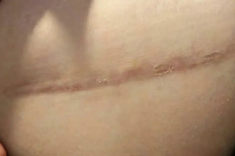 剖腹产刀口变化过程图