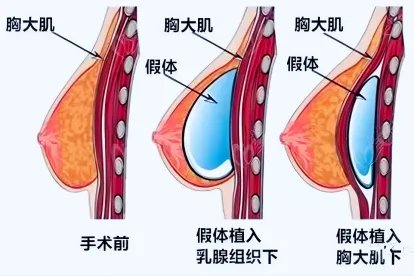 假体隆胸手术图片