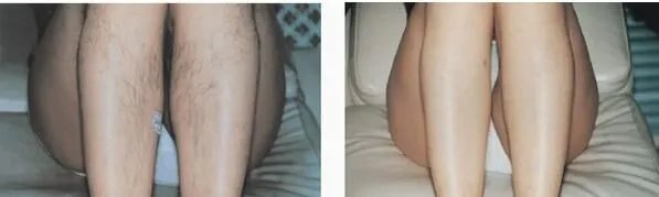 北京冰点脱毛价格是多少