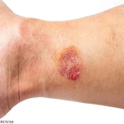 被电伤了皮肤怎么处理