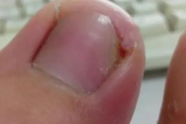 灰指甲早期图片