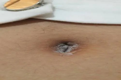 肚脐眼发白图片