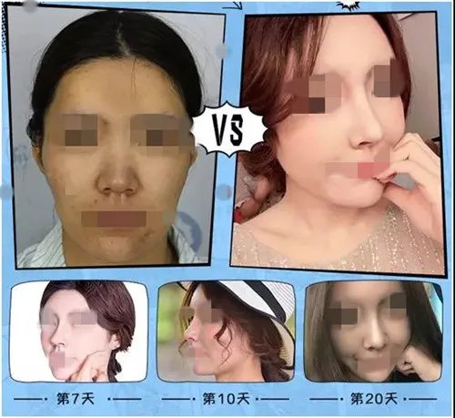 硅胶隆鼻前后对比