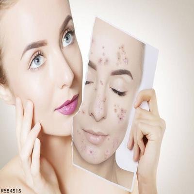 青春痘疤痕修复 如何快速修复青春痘疤痕