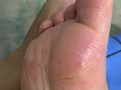 水疱型足癣小水疱图片