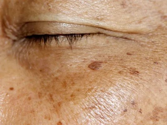 瓷肌祛斑怎么样