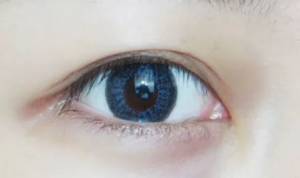 北京开眼角多少钱