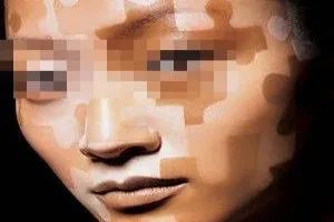 白颠疯病初期是什么样的症状