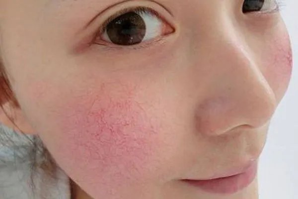 推荐去除红血丝五种小偏方