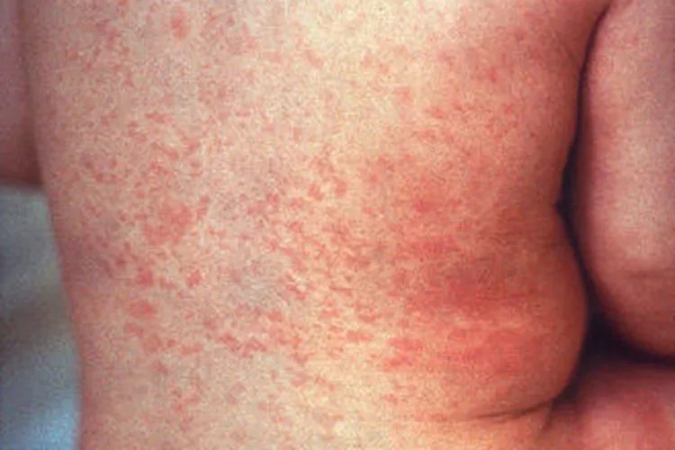 幼儿风疹的症状图片