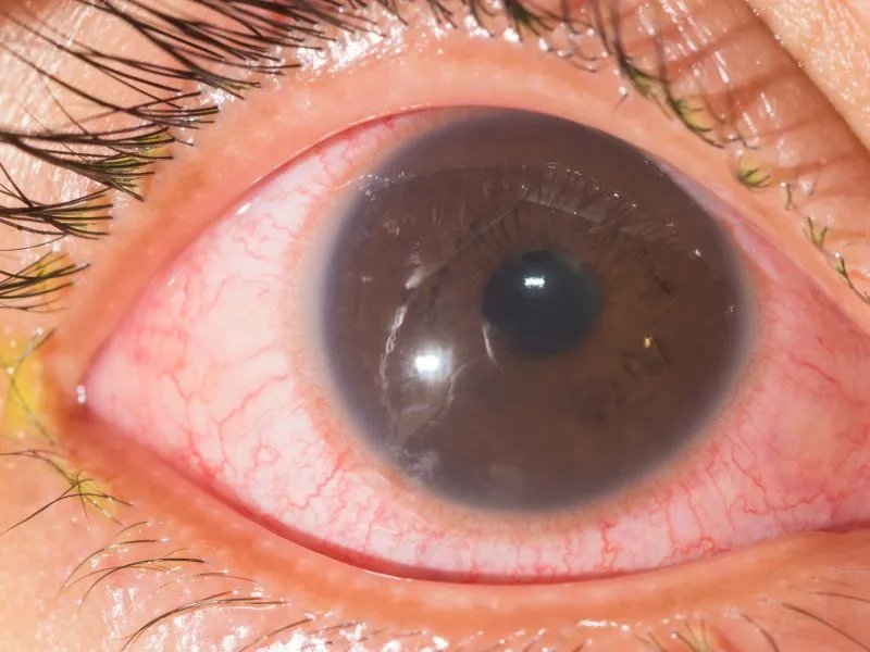 孕妇得红眼病怎么办