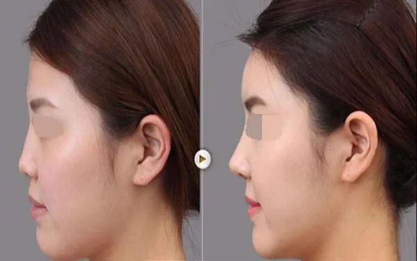 北京隆鼻哪些医院比较好？