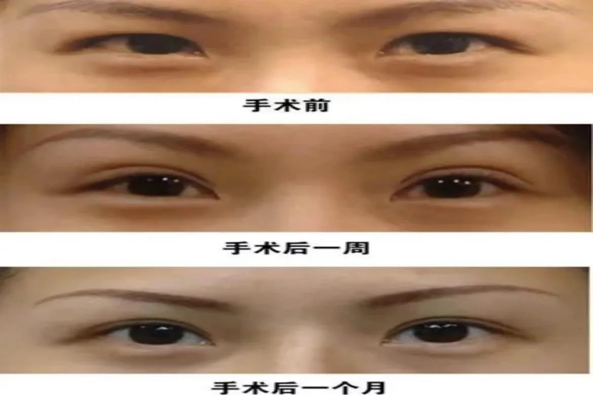 埋线双眼皮前后对比图