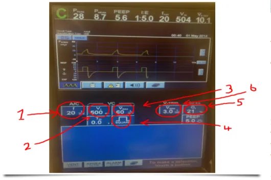 呼吸机数值代表的意义图解