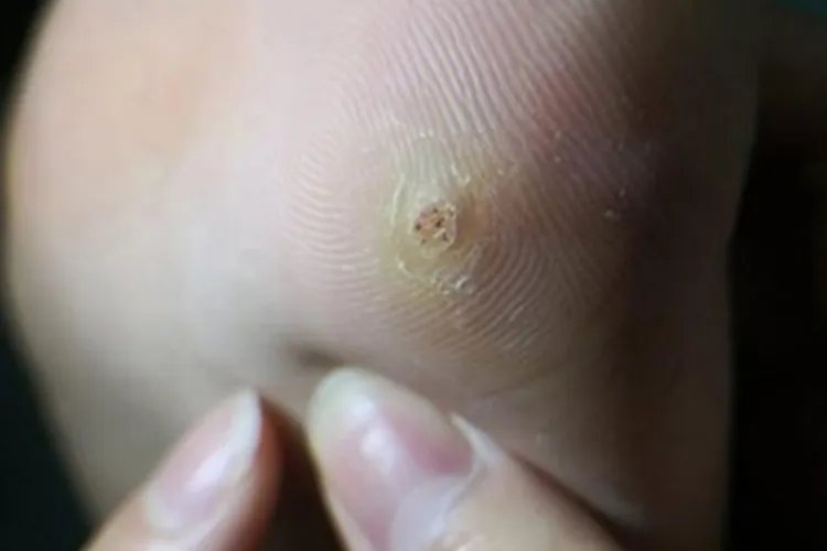 硬鸡眼脚底疙瘩图片