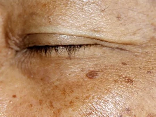 年轻人老年斑怎么去除