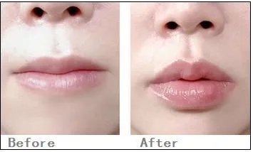 玻尿酸丰唇术多少钱