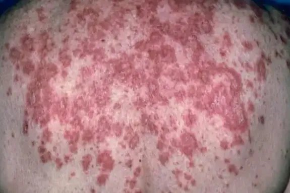 红斑狼疮症状图片