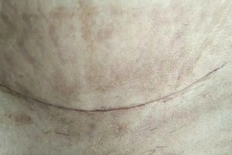 剖腹产刀口变化过程图