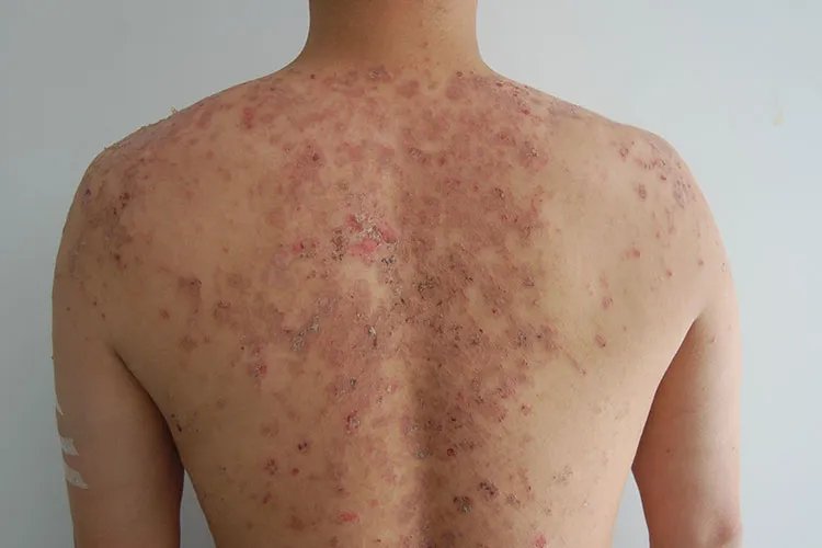 皮炎性湿疹的症状图片