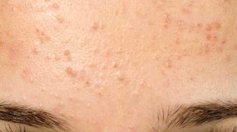 北京去痘印最有效的方法