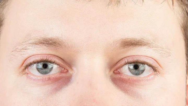 治疗近视的方法都有哪些 想要治疗近视怎么办才好