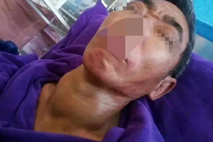 颈瘿的准确位置图