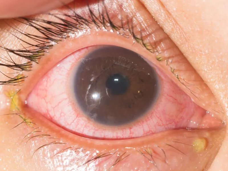 慢性过敏性结膜炎的症状有哪些