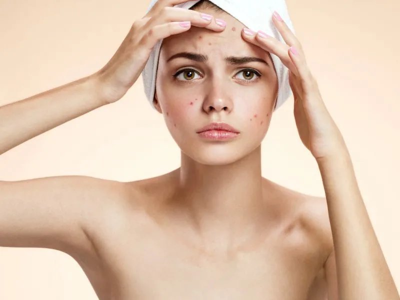 男生如何去粉刺