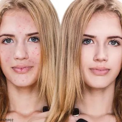 怎样去额头上的痘痘 去额头上痘痘6妙招分享