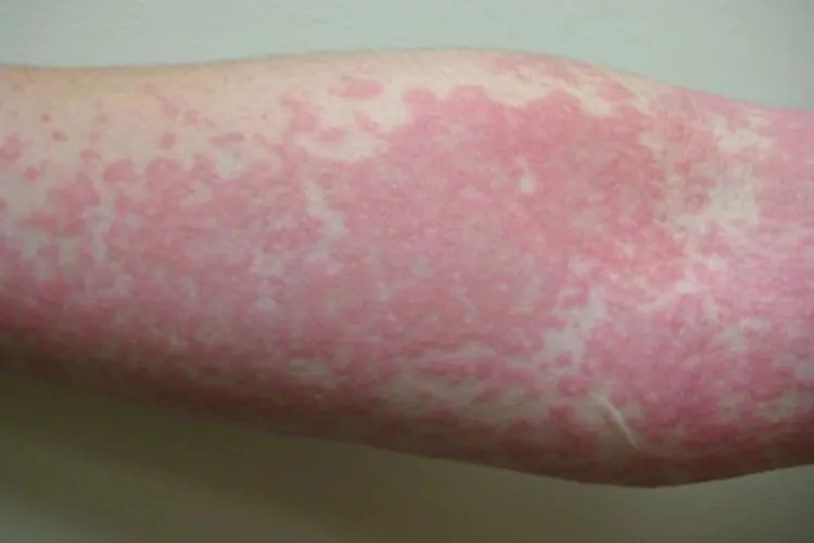 猩红热症状图片