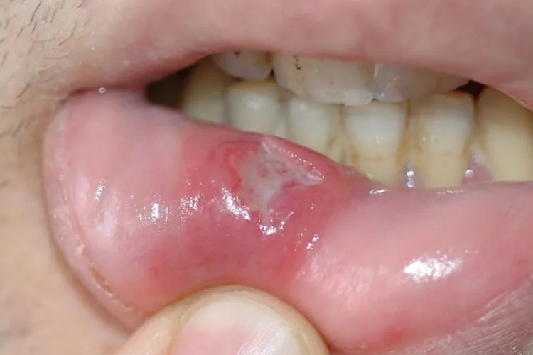 红斑狼疮早期10个征兆图片