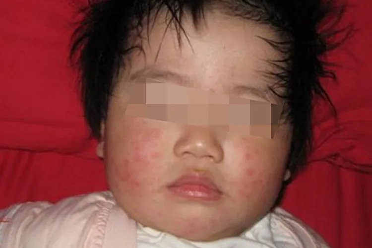 幼儿风疹的症状图片