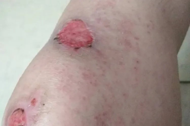 猩红热症状图片