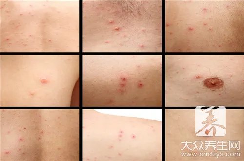  身上起了好多红疙瘩很痒怎么办