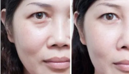 玻尿酸除皱术要注意哪些