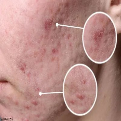 成人痤疮是什么原因引起的