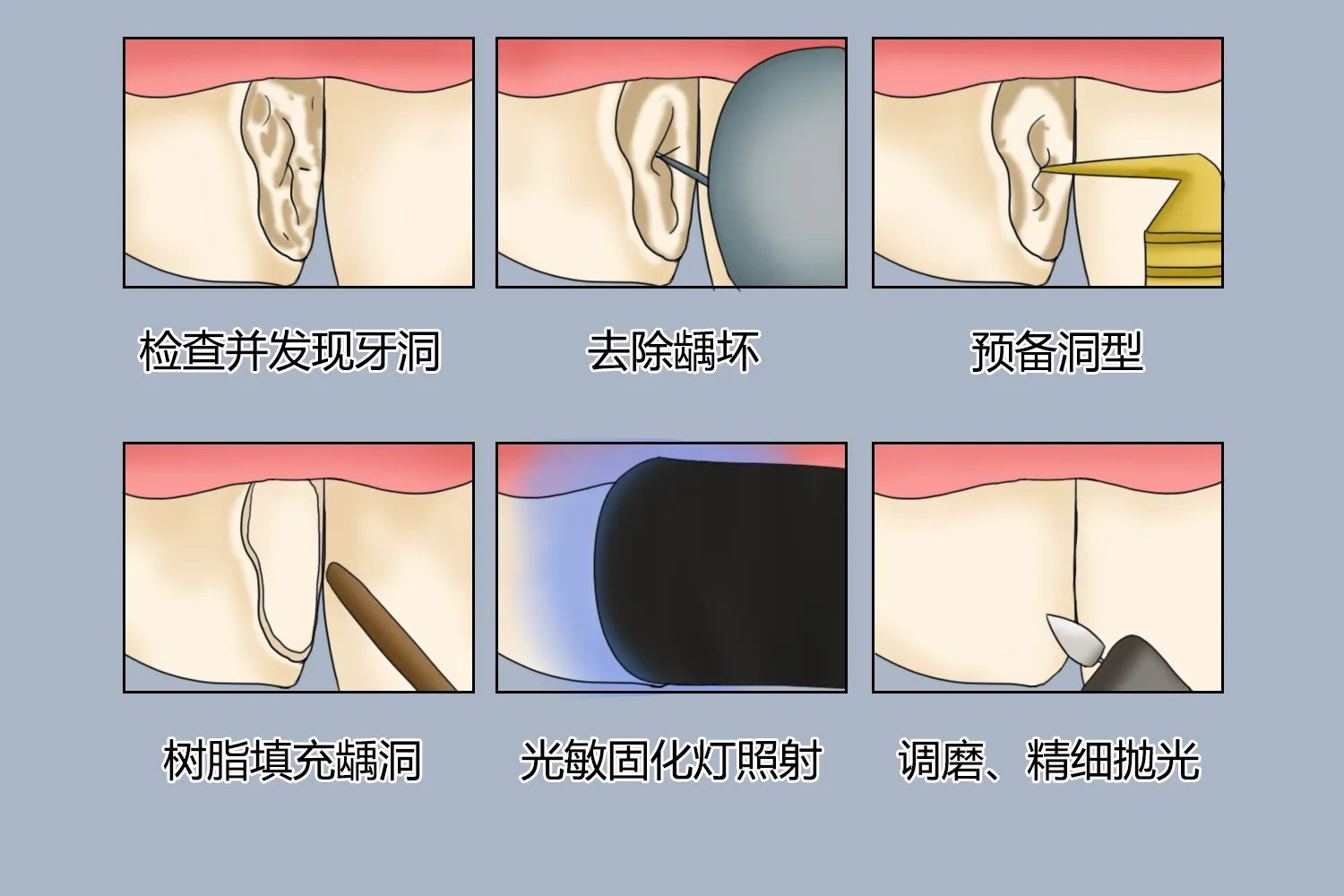 侧面补牙过程图解