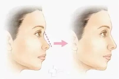 瑞蓝注射隆鼻价格