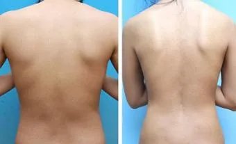 背部吸脂减肥价格