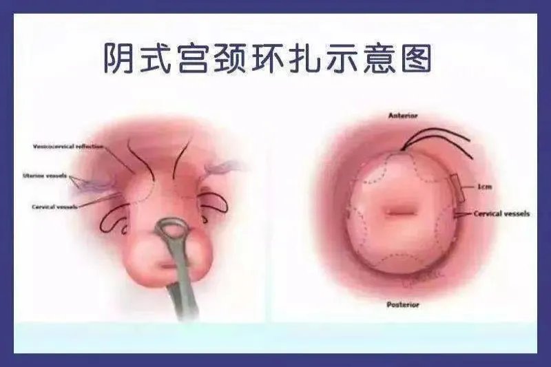 宫颈环扎术图片