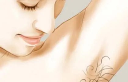 激光脱毛安全吗