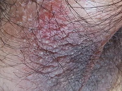 湿疹阴囊症状图片