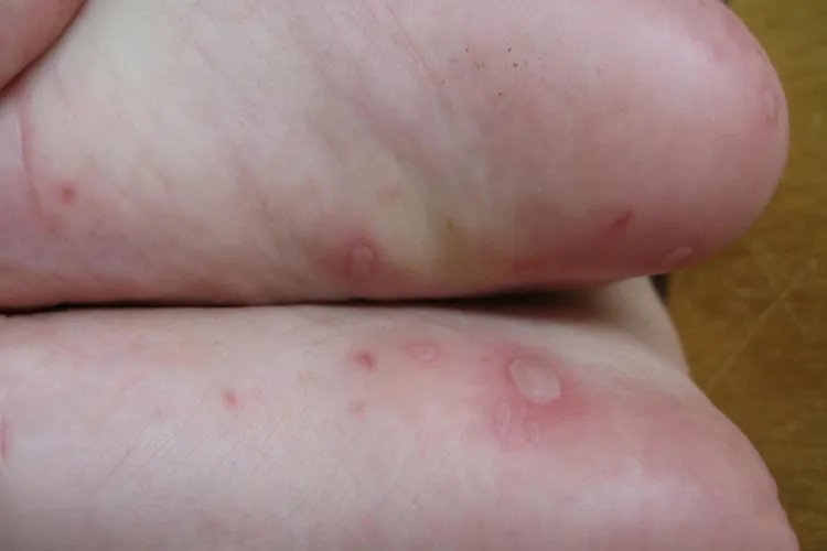 手足口病的样子图片