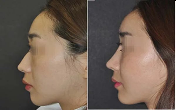 韩式硅胶隆鼻三段区别及优势
