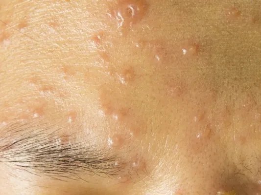 复合彩光祛痘注意事项