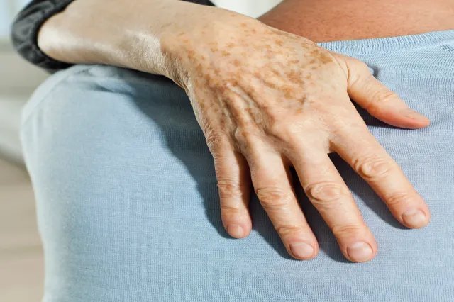 年轻人手上长老年斑图片