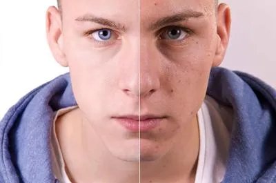 怎么样才能祛斑祛痘