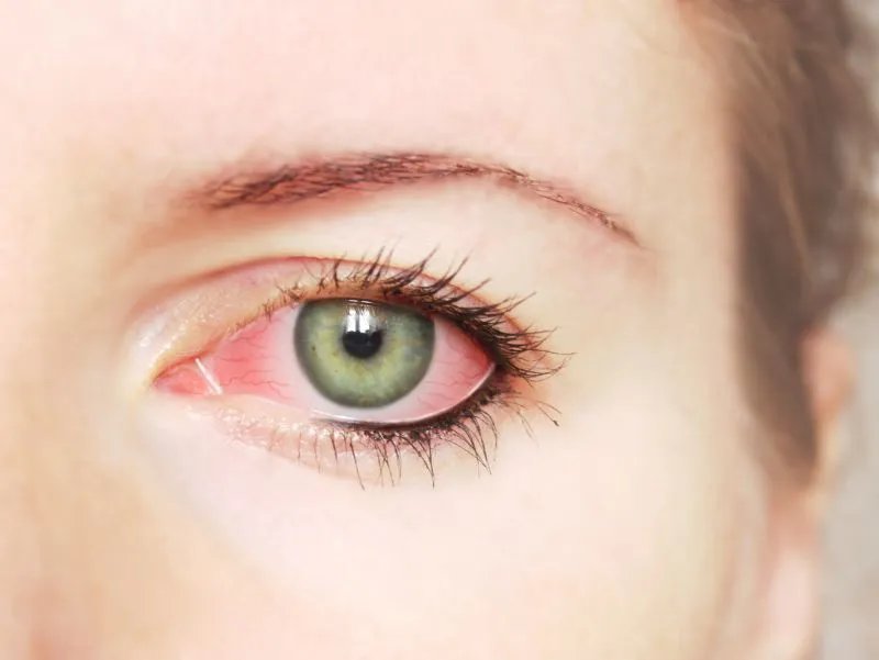 出现红血丝的原因